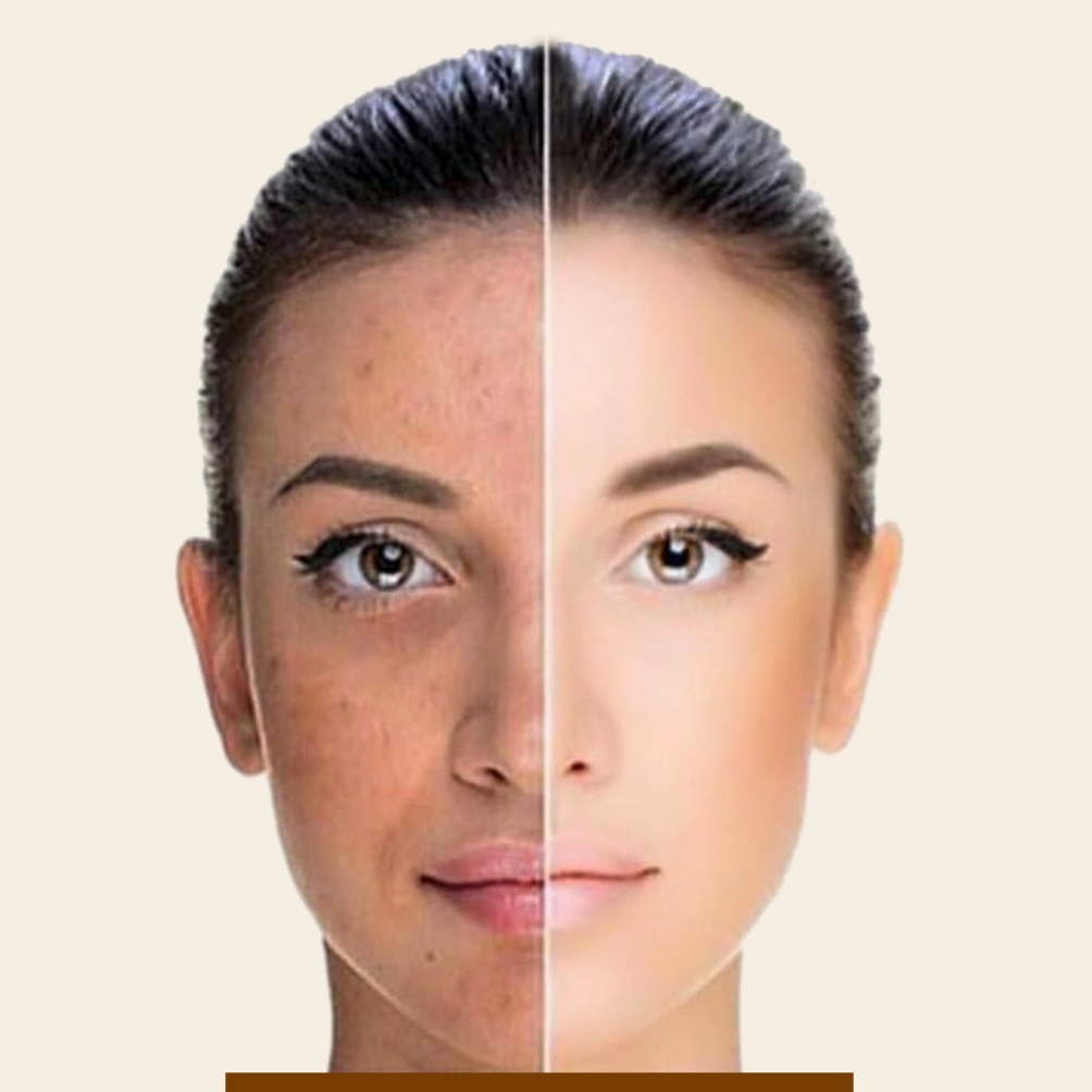 Acne Treatments